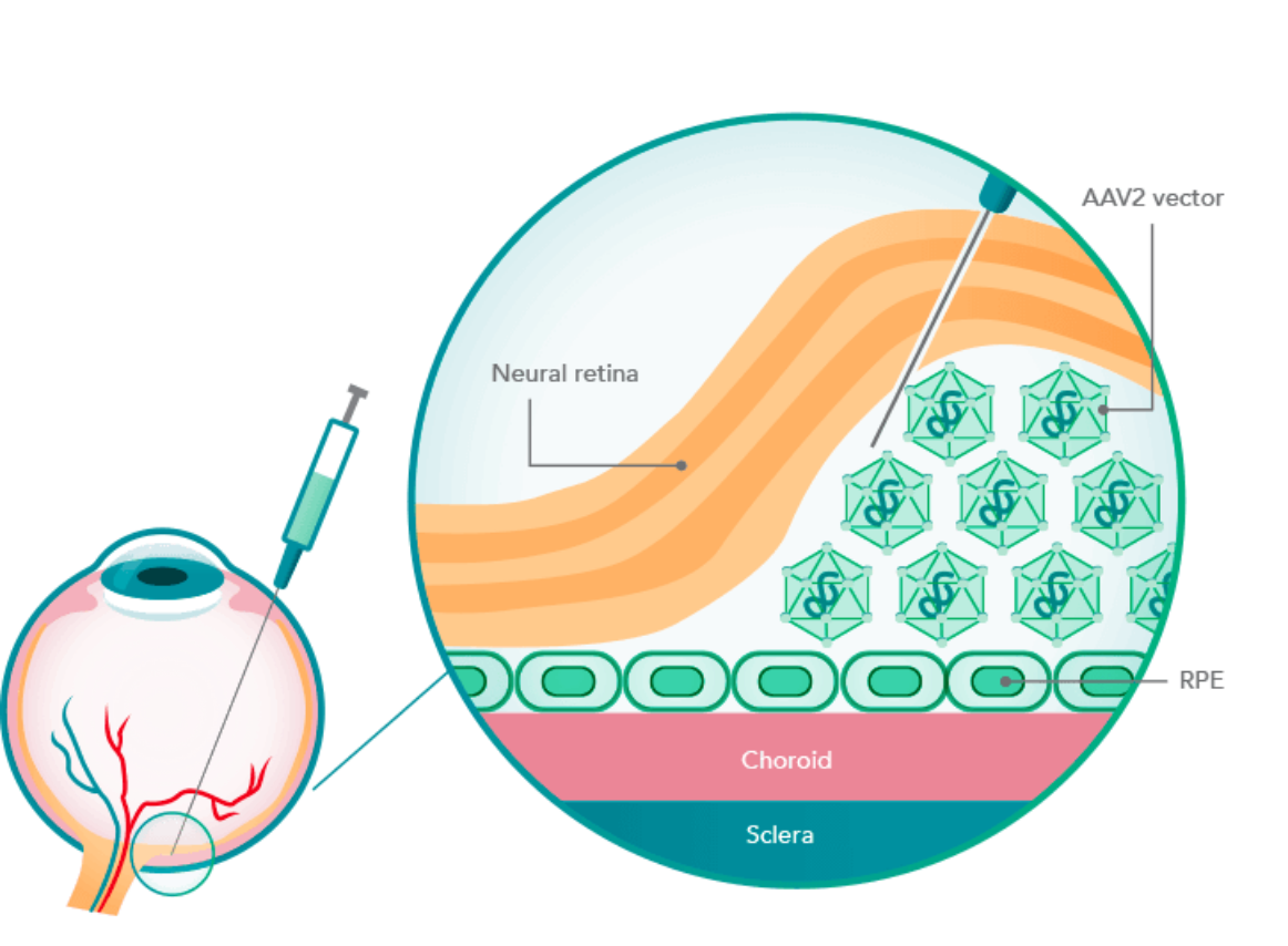 Illustration of the RPE65 gene delivery method